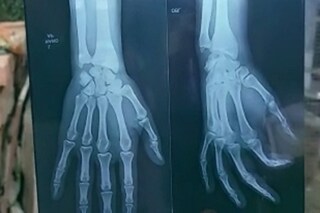 hand-fracture-1300-e0a495e0a4b0e0a58de0a4aee0a49ae0a4bee0a4b0e0a580-e0a4b9e0a4a1e0a4bce0a4a4e0a4bee0a4b2-e0a4aae0a4b0-e0a4ace0a58be0a4b2-1 hand fracture